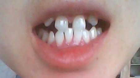 牙疏